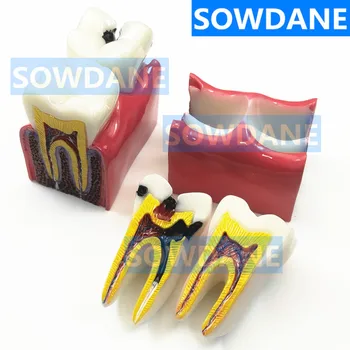 1 шт. Модель зубов для обучения анатомии зубов 6 раз Сравнительные модели исследования кариеса для изучения и исследования стоматолога